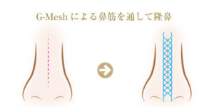 G-Meshによる美鼻施術